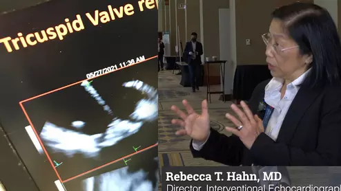 Interview with Rebecca T. Hahn, MD, Professor of Medicine at Columbia University Irving Medical Center, Chief Scientific Officer of the Echo Core Lab at the Cardiovascular Research Foundation and Director of Interventional Echocardiography at the Columbia Structural Heart and Valve Center. She discusses some of the trends of growing use of interventional echocardiographic guidance in transcatheter structural heart procedures, the growing number of tricuspid valve procedures, and use of 3D ICE.