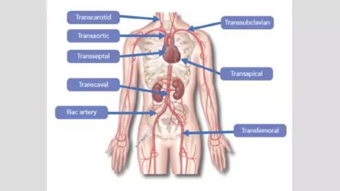 transcarotid TAVR TAVI transcatheter aortic valve replacement