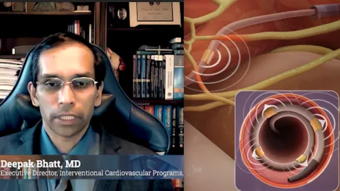 Deepak Bhatt, MD, discusses the long-term, positive SYMPLICITY HTN-3 trial results presented at TCT 2022, and the future of renal denervation therapy to treat hypertension. #TCT