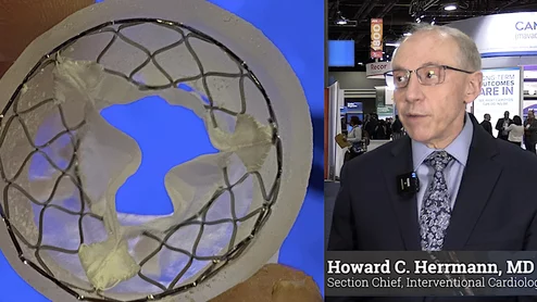 Video of Howard Herrmann, MD, explaining the details of the SMART trial that looked at TAVR in small annulus and found self-expanding TAVR valves work better in these patients than balloon-expanding TAVR at ACC.24. #ACC24 #ACC2024