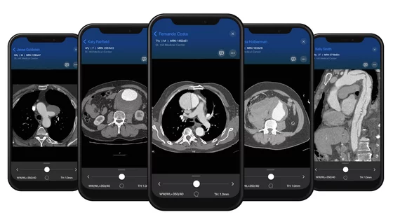 Examples of CT imaging showing aortic dissections on an acute AAA response team app that was recently cleared by the FDA from Viz.AI. 
