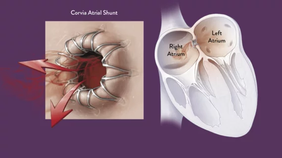 The Corvia Atrial Shunt is designed to address elevated left atrial pressure (LAP) heart failure patients.