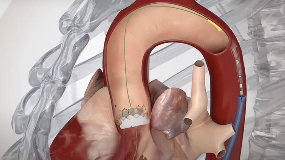 The Edwards Lifesciences Sapien transcatheter aortic valve replacement (TAVR) device in a heart model used to show patients how the device works.