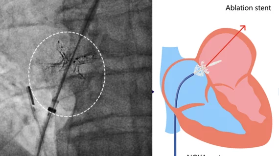 Researchers are using an intra-atrial shunt to lower pressures between the upper chambers of the heart to relieve symptoms in HFpEF heart failure patients. The novel Noya device uses an RF ablation to cut a hole into the septum and then enlarge it using a stent that can then be removed from the body after the procedure. 