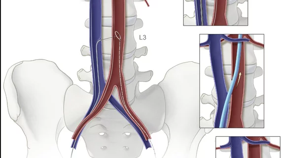 The steps involved to gain transcaval access between the inferior vena cava and the aorta to avoid problematic anatomical areas that would have otherwise disqualified a patient for a femoral access TAVR procedure. Illustration of the NIH
