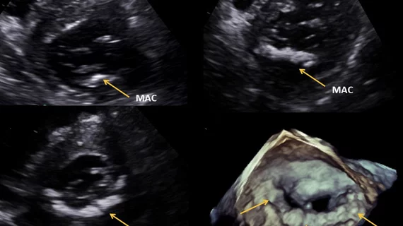 Examples of mitral annulus calcification (MAC) visualized using echocardiography. Image from the journal Echocardiography. 