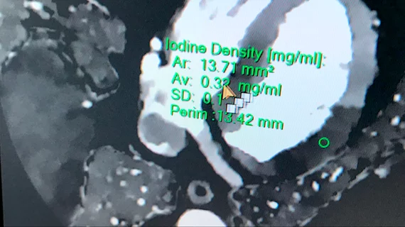 An example of spectral cardiac CT being used to show iodine density in the myocardium to show perfusion deficits. Shown by Philips healthcare at ACC 2022. 