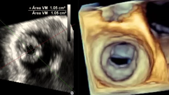 A 3D echo of a rheumatic mitral valve and a 2D image of the same valve showing the irregularly shaped valve opening. Images are part of the figures in the new ASE guidelines.