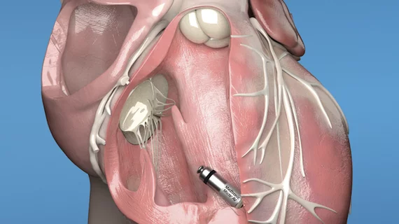 The Medtronic Micra leadless pacemaker implanted inside the heart. It is about the size of a large vitamin pill and is implanted using a catheter. 