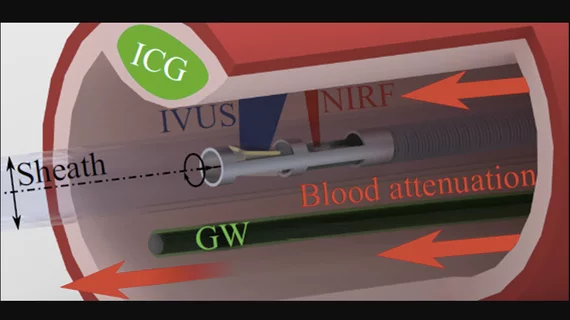 The variable fluorescence attenuation of blood has been a hindrance to near-infrared fluorescence (NIRF) measurements in cardiovascular imaging. Fortunately, researchers have devised an innovative correction method in which the guidewire (GW) is coated with the fluorescent agent (ICG) and used as a reference standard in each frame, leading to a much higher accuracy. Credit: Rauschendorfer et al., doi 10.1117/1.JBO.28.4.046001