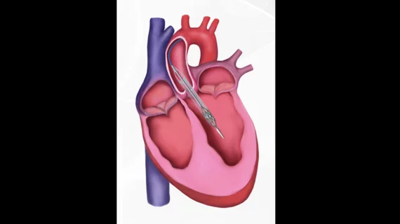 Magenta Medical Elevate Heart Pump