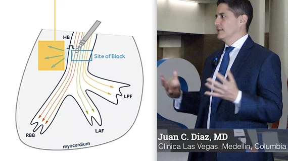 Juan Diaz, MD, explains why left bundle branch (LBB) conduction pacing is better than conventional sinus node pacing in cardiac synchronization therapy (CRT) for heart failure patients. #HRS #HRS2023 #LBBAP