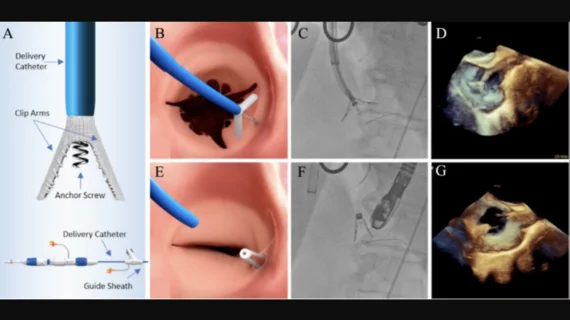 K-Clip annuloplasty system for tricuspid regurgitation by Shanghai Huihe Medical Technology Co. 