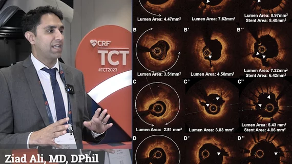 Ziad Ali, MD, explaines the impact of coronary intravascular lithotripsy (IVL) use in nodular and eccentric calcium morphologies at TCT 2023. IVL was found to produce better outcomes than atherectomy or high pressure balloons. #TCT #TCT2023 #TCT23 #IVL 