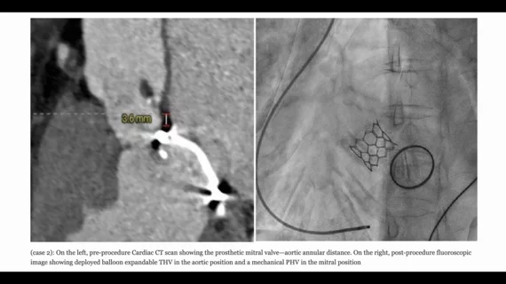 TAVR after mitral valve replacement 