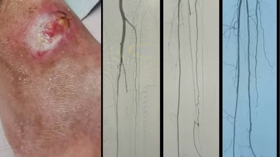 A diabetic foot ulcer that does not heal due to low blood supply from peripheral artery disease (PAD), and the before and after interventional angiograms of the patient's revascularization treatment. Images courtesy of Foluso Fakorede, MD