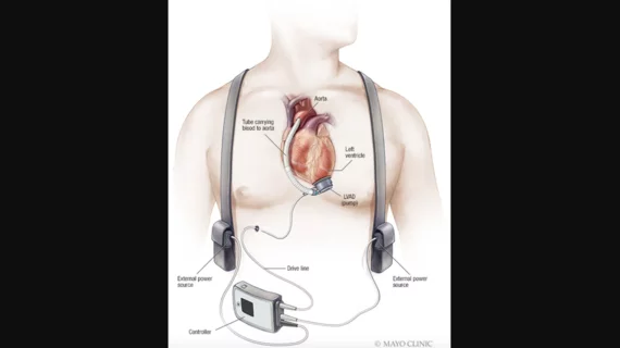 Patient with LVAD