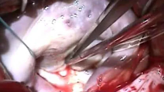 A mitral valve open heart surgical repair.